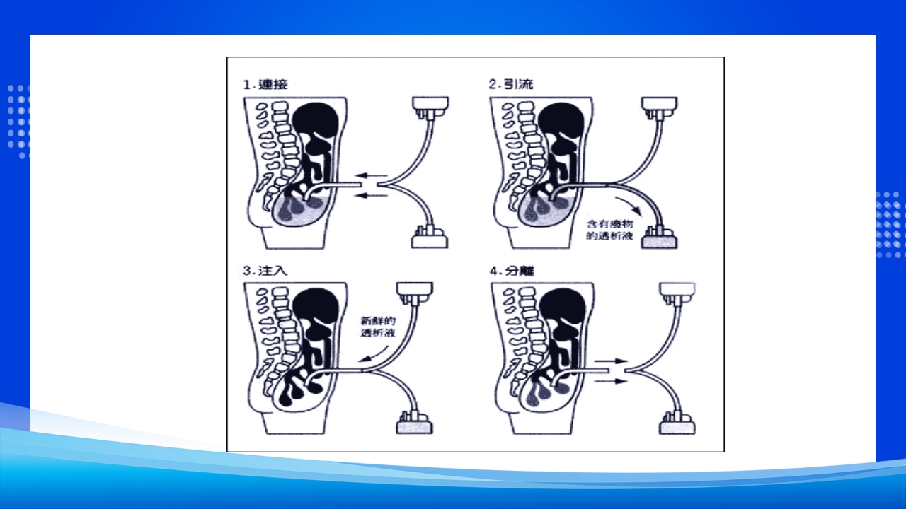 腹膜透析PPT课件下载15