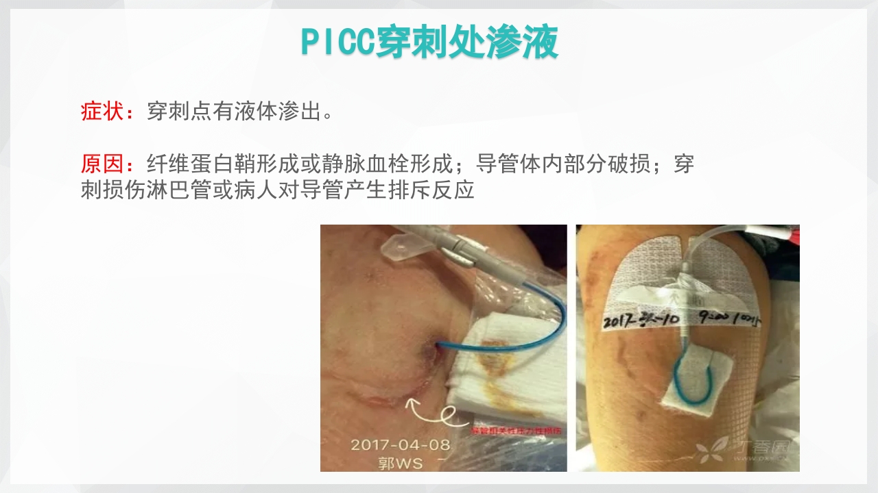 PICC置管后常见并发症的处理PPT课件19
