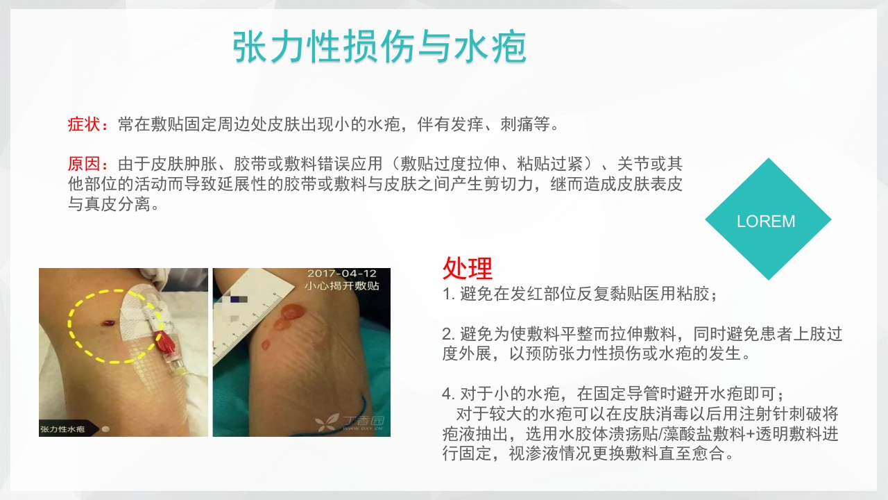 PICC置管后常见并发症的处理PPT课件29