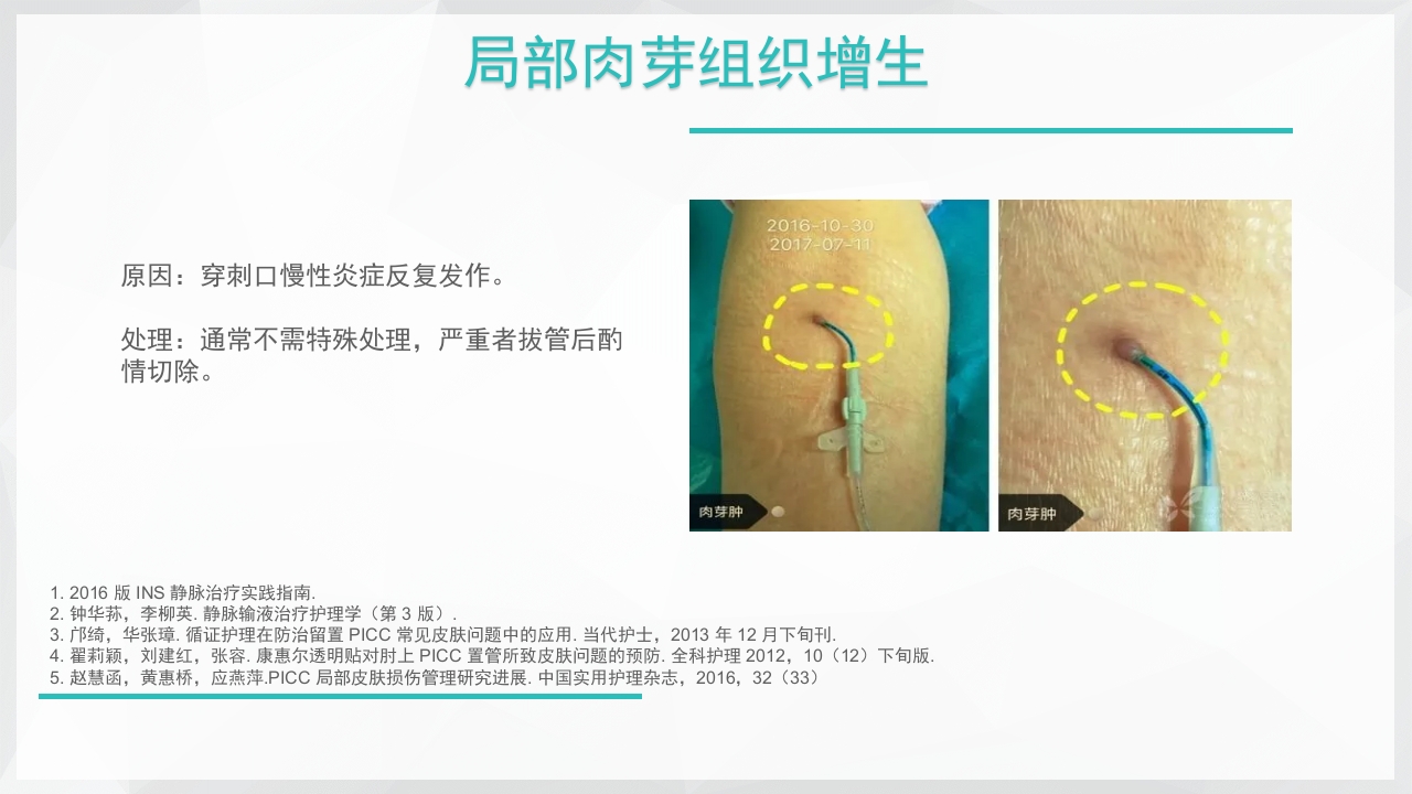 PICC置管后常见并发症的处理PPT课件32