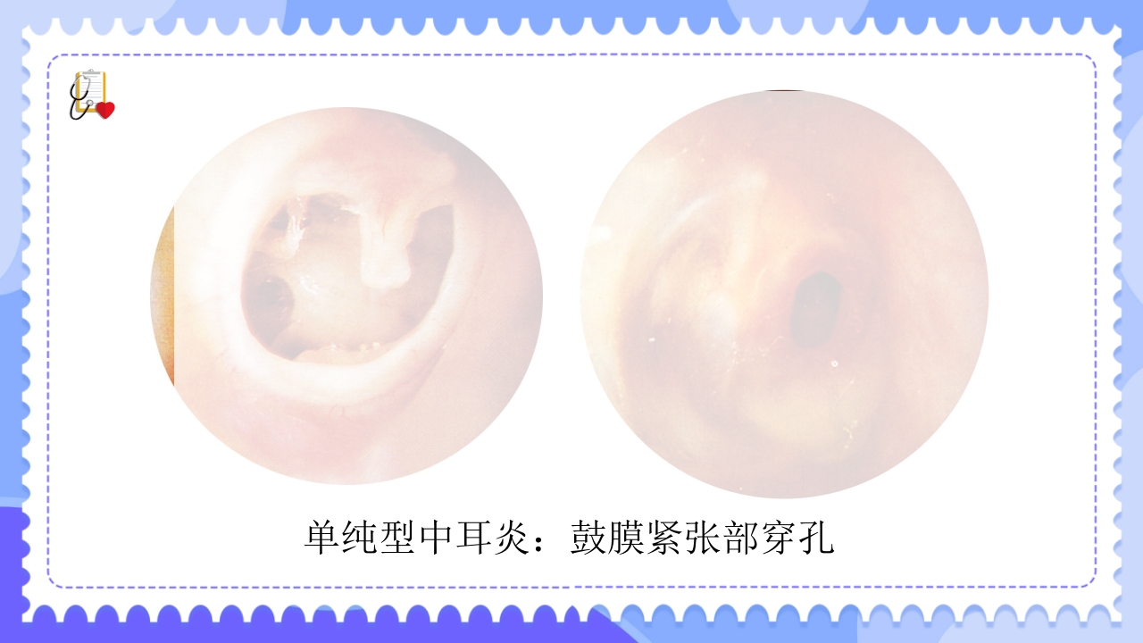 慢性化脓性中耳炎病人的护理PPT课件13
