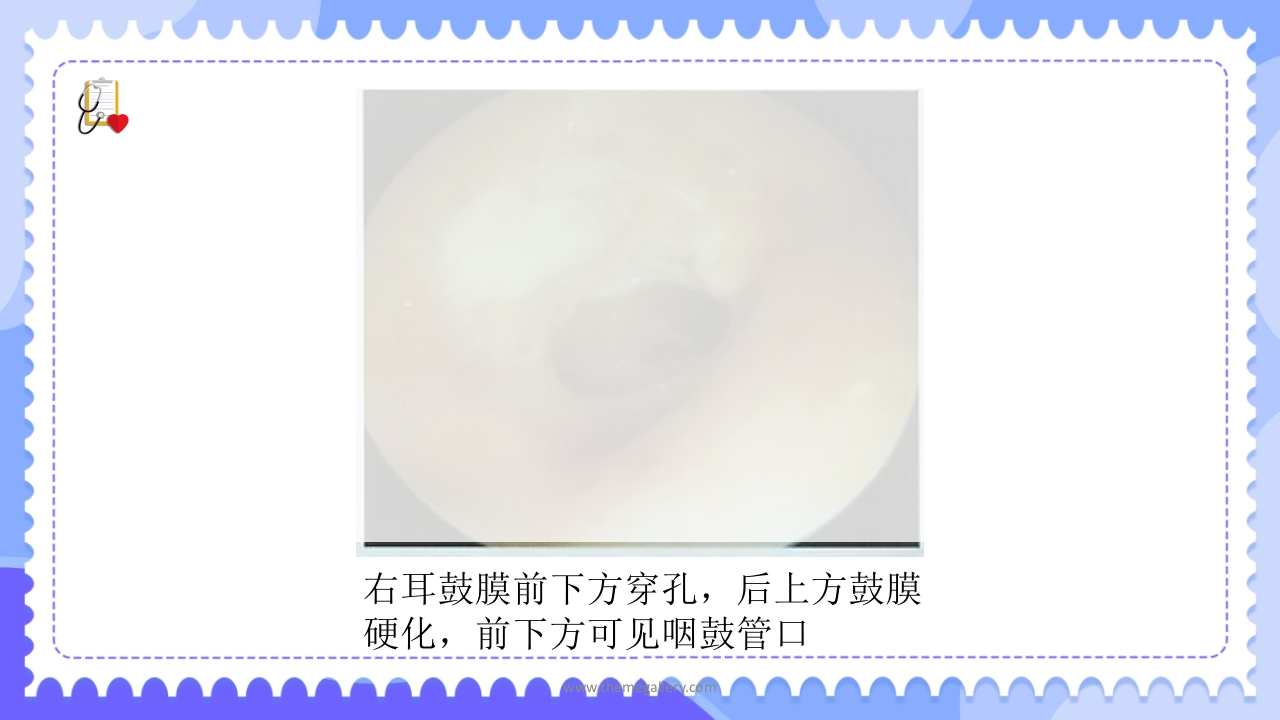 慢性化脓性中耳炎病人的护理PPT课件14