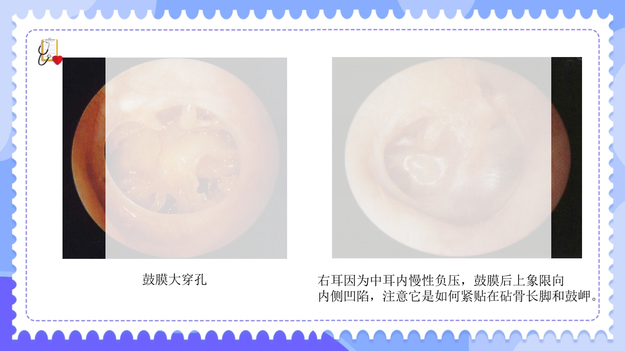 慢性化脓性中耳炎病人的护理PPT课件15