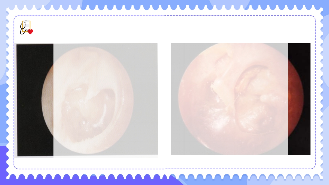 慢性化脓性中耳炎病人的护理PPT课件16