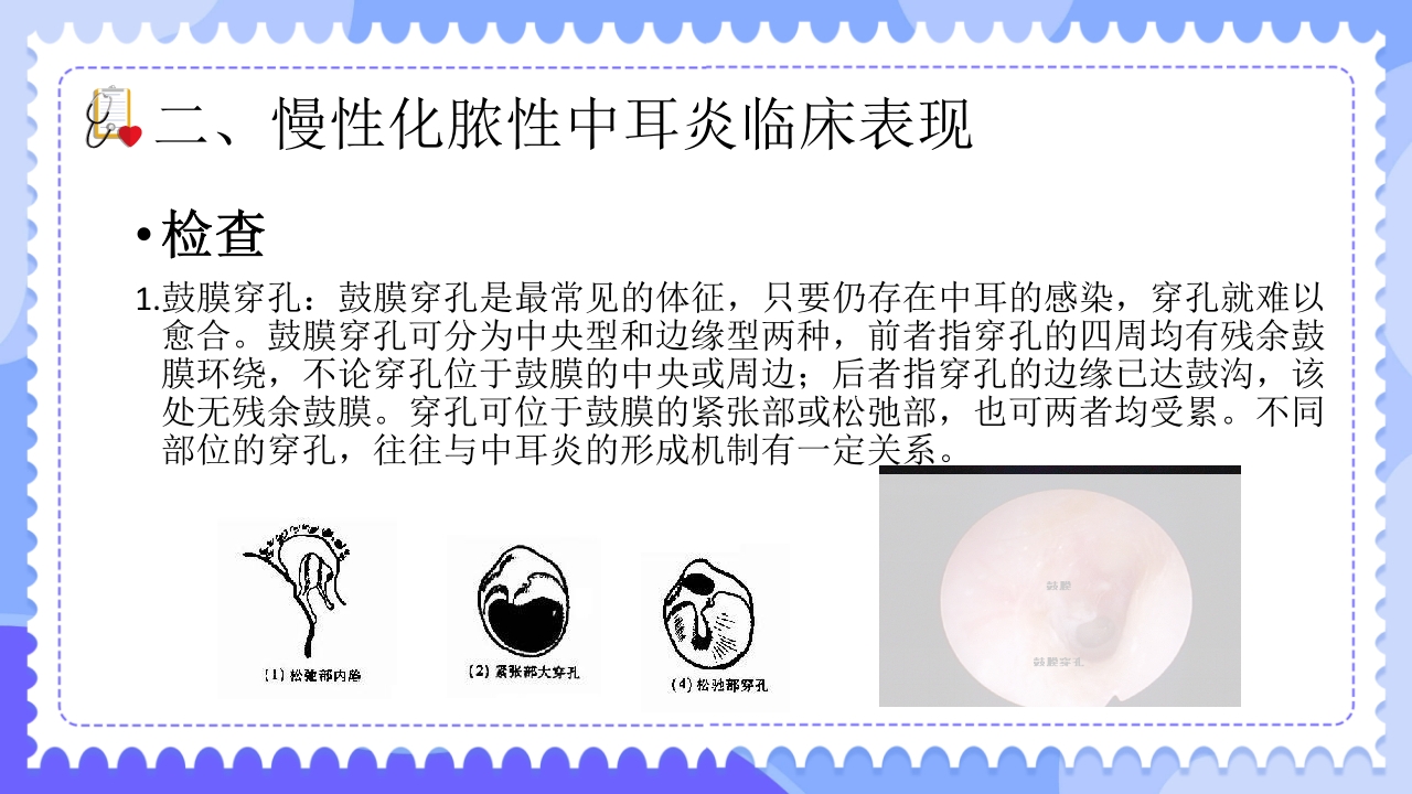 慢性化脓性中耳炎病人的护理PPT课件7