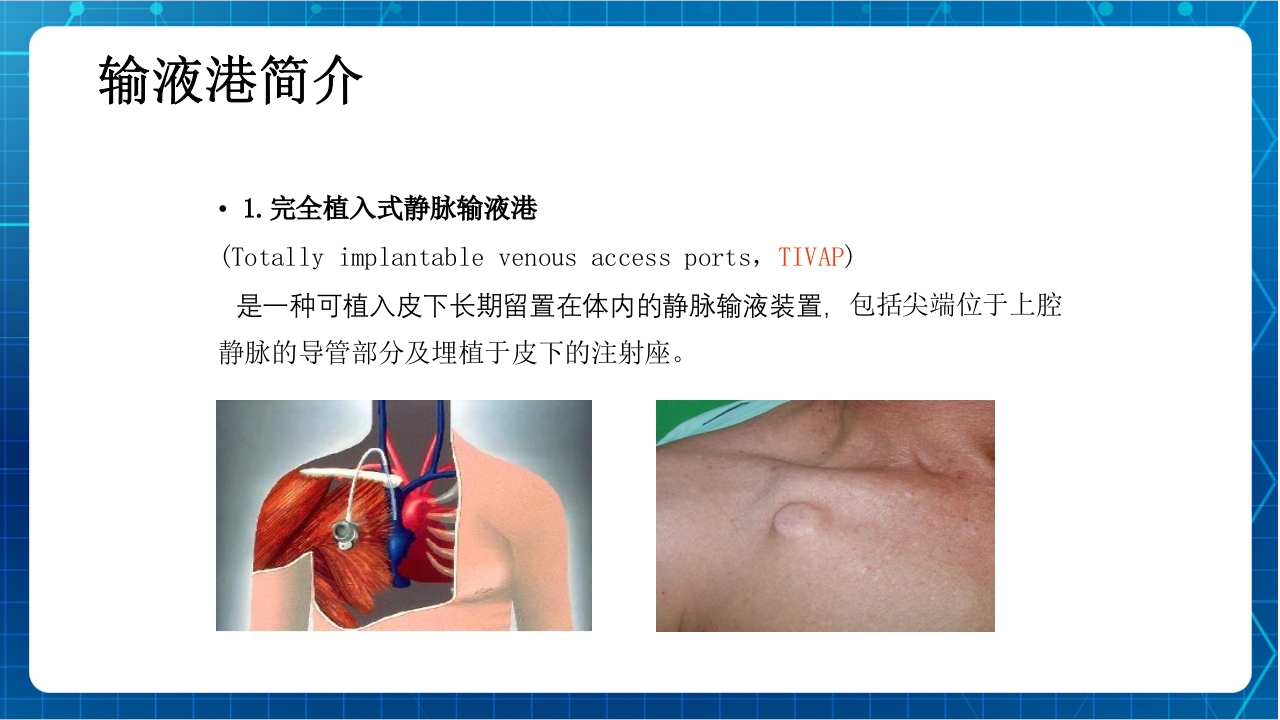 PICC与输液港的使用及维护PPT课件下载12