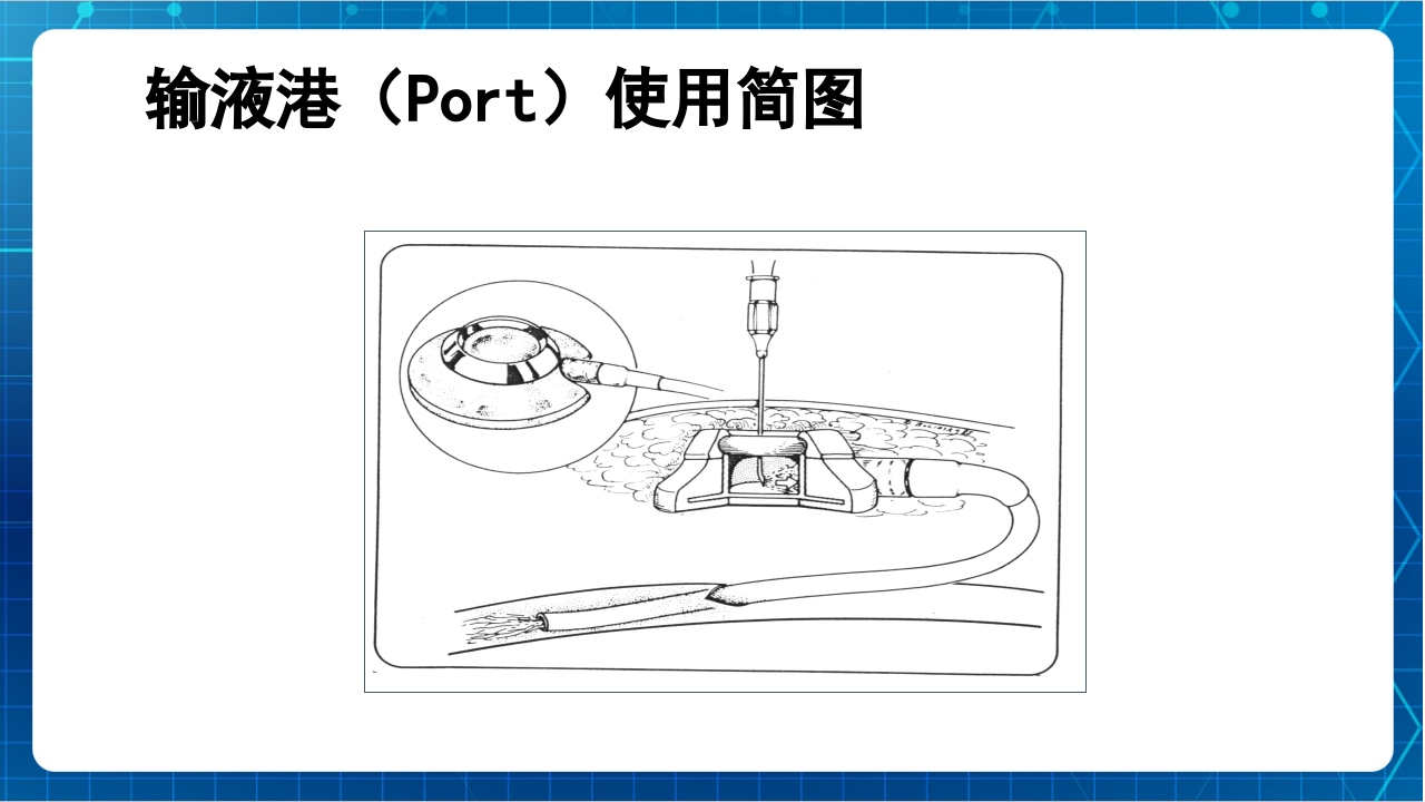 PICC与输液港的使用及维护PPT课件下载13