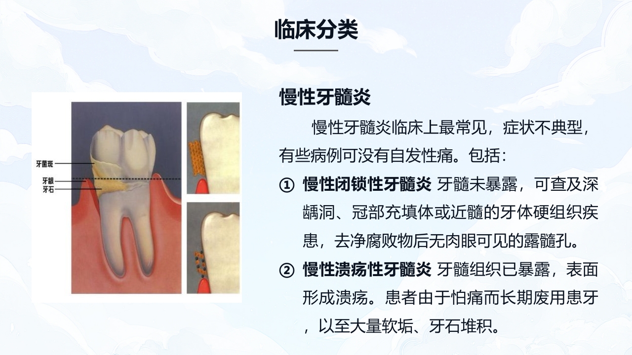 牙髓炎的护理查房PPT课件下载6