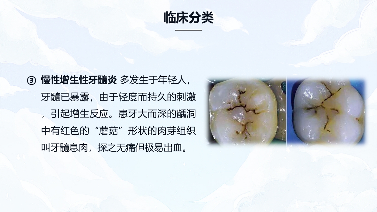 牙髓炎的护理查房PPT课件下载7