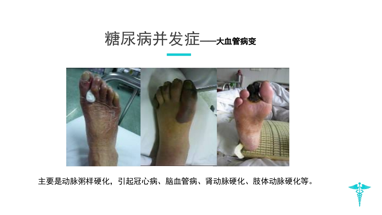 糖尿病教学PPT课件下载17