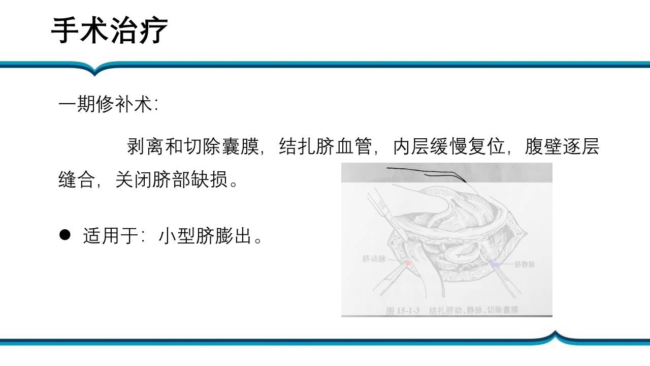 脐膨出患儿的护理PPT课件下载12