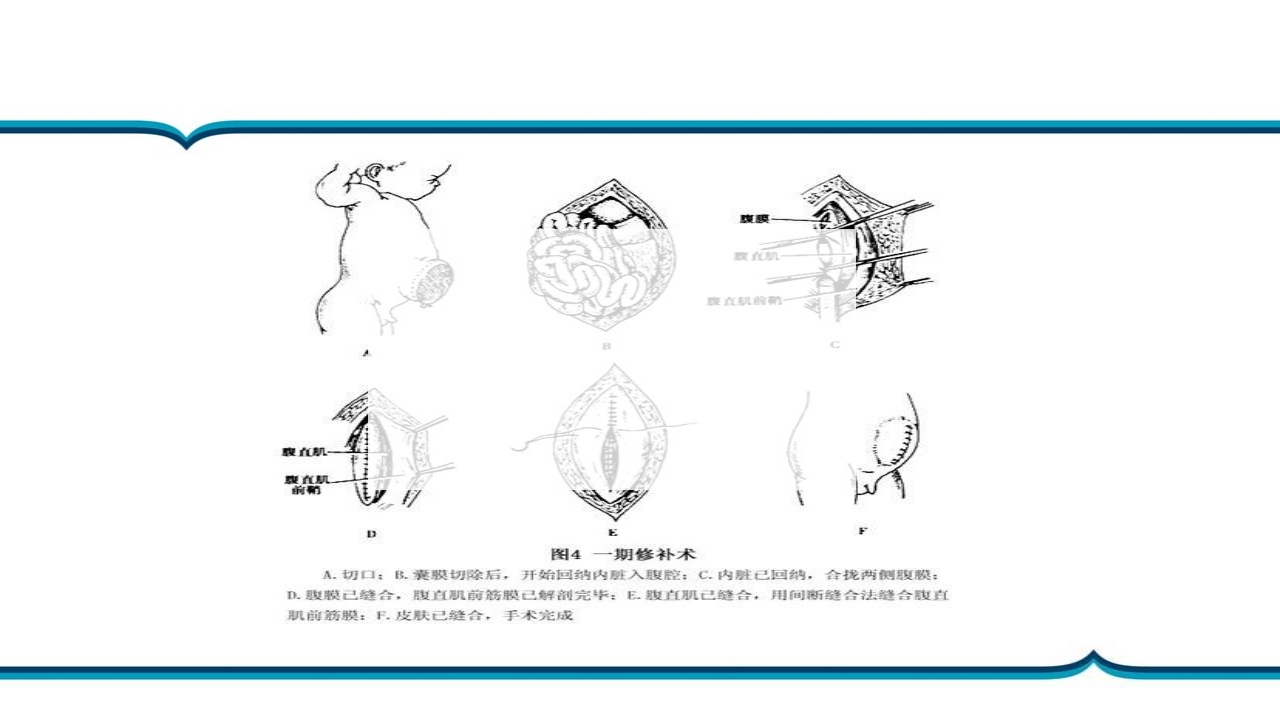 脐膨出患儿的护理PPT课件下载13