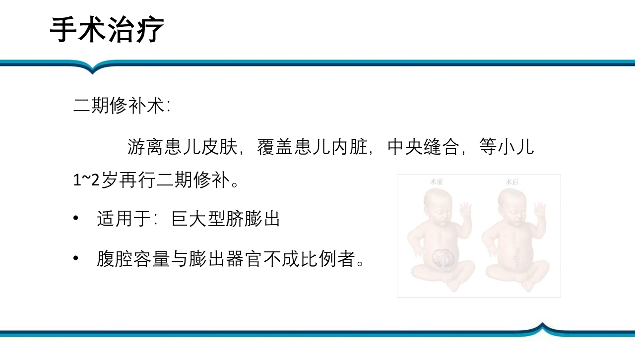 脐膨出患儿的护理PPT课件下载14