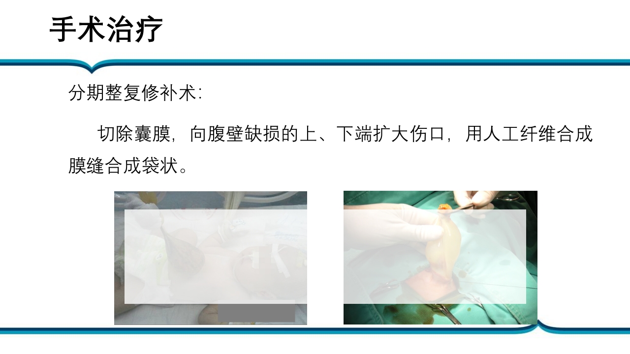 脐膨出患儿的护理PPT课件下载15