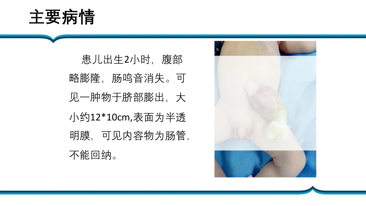 脐膨出患儿的护理PPT课件下载17
