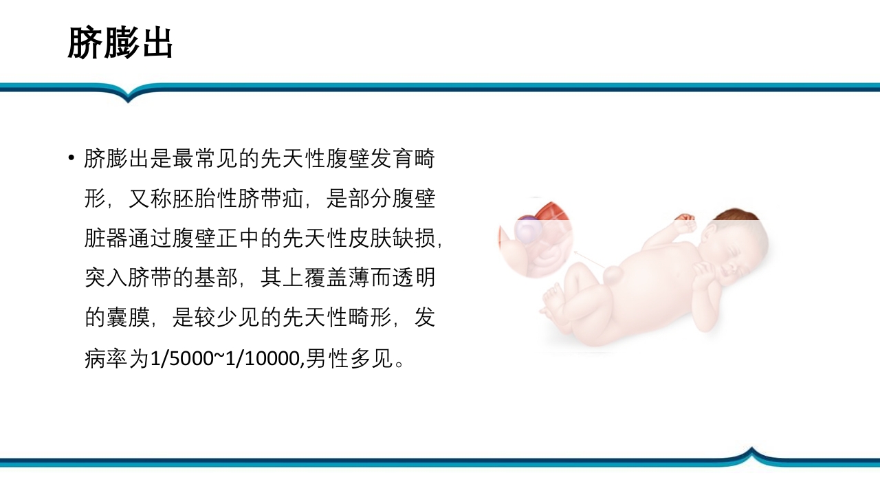 脐膨出患儿的护理PPT课件下载3