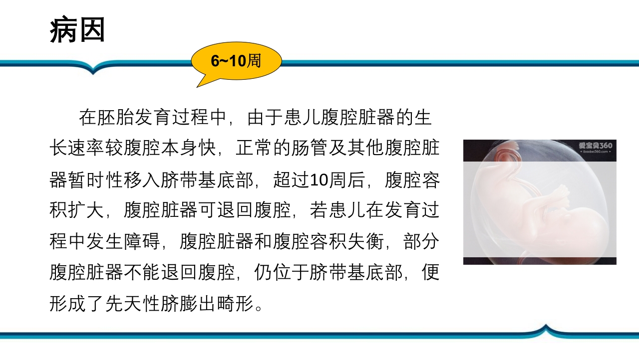 脐膨出患儿的护理PPT课件下载5