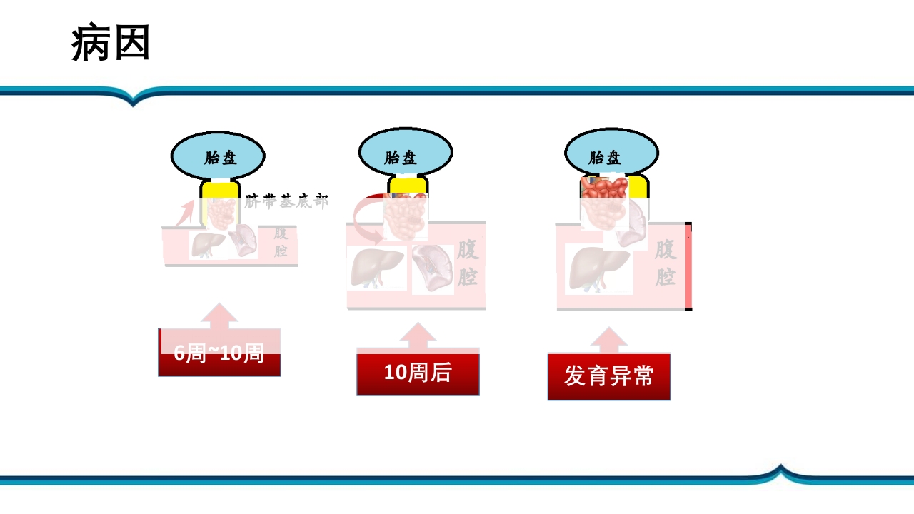 脐膨出患儿的护理PPT课件下载6