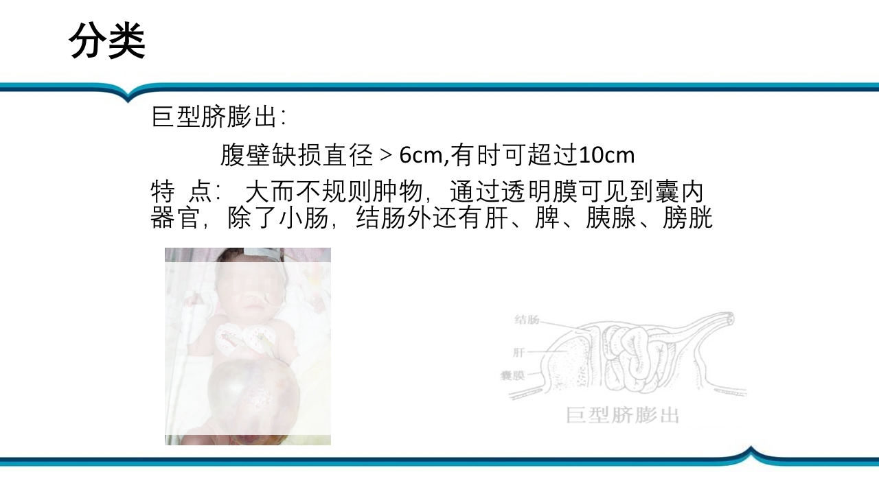 脐膨出患儿的护理PPT课件下载7