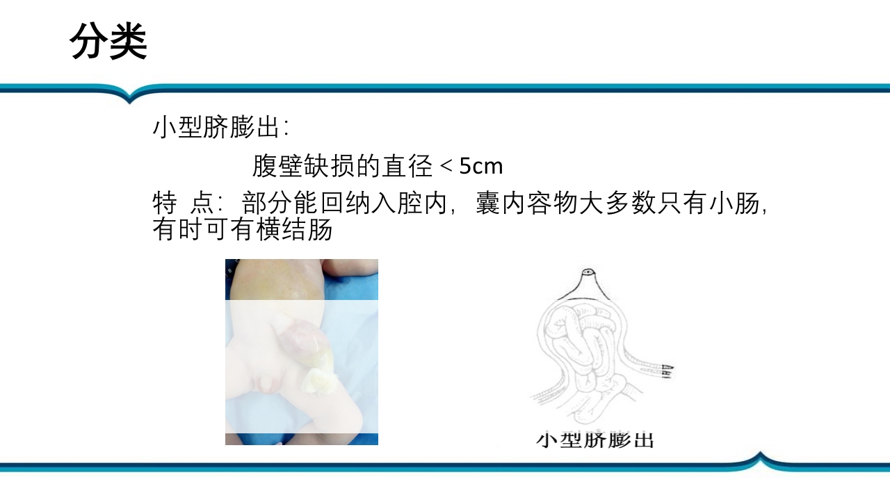 脐膨出患儿的护理PPT课件下载8