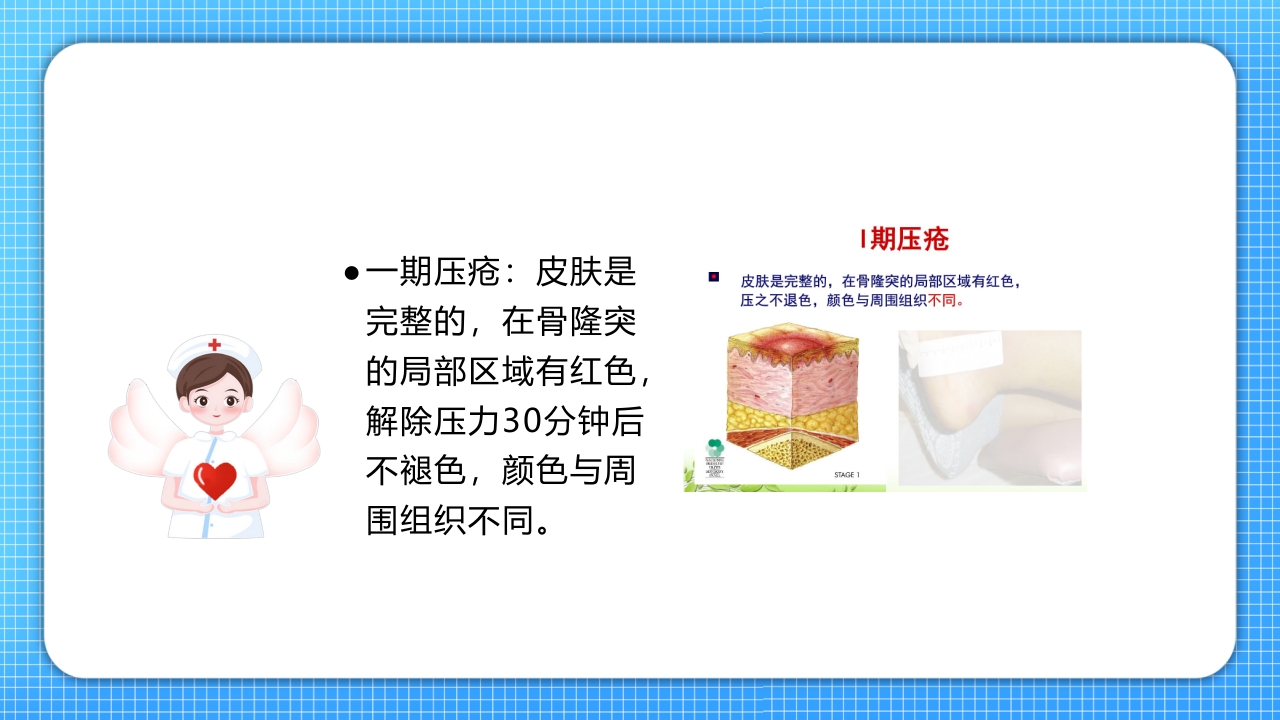 医疗压疮护理查房PPT课件18