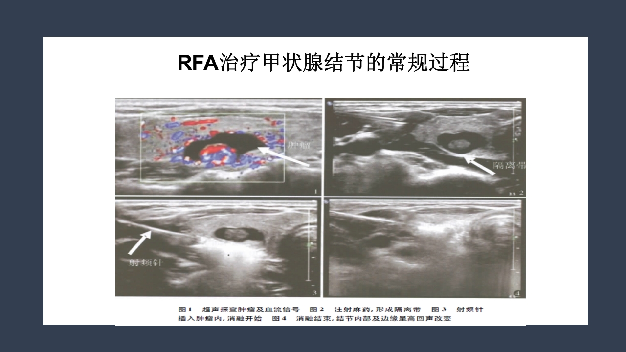 超声引导下甲状腺结节射频消融PPT课件17