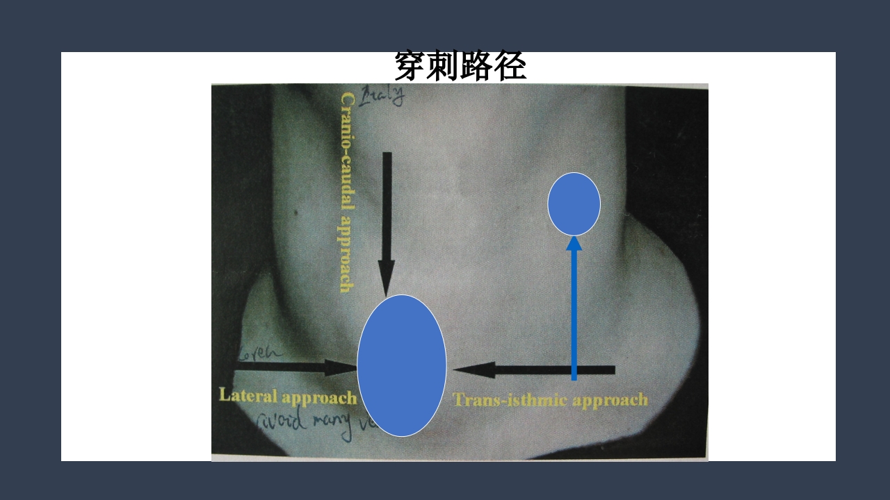 超声引导下甲状腺结节射频消融PPT课件18