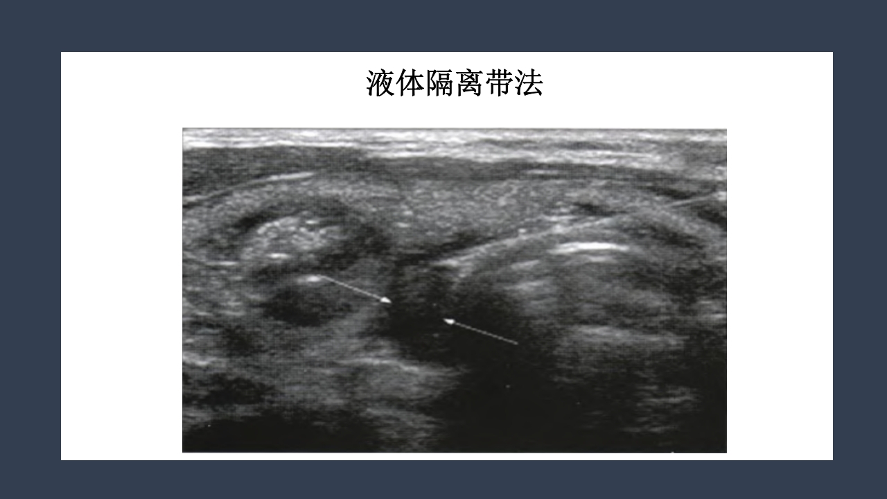 超声引导下甲状腺结节射频消融PPT课件31