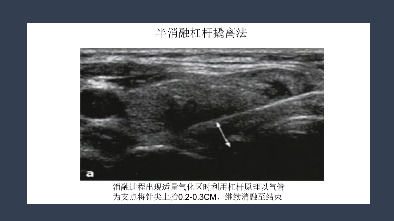 超声引导下甲状腺结节射频消融PPT课件34