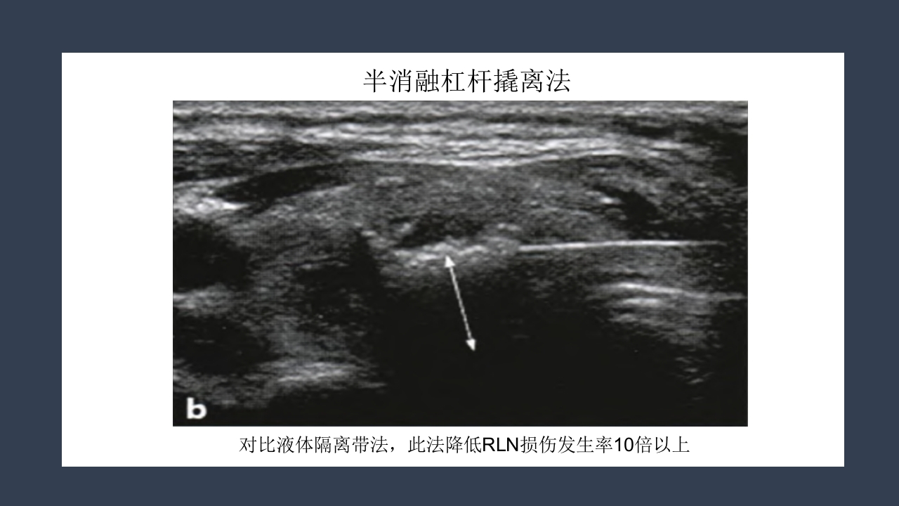 超声引导下甲状腺结节射频消融PPT课件35