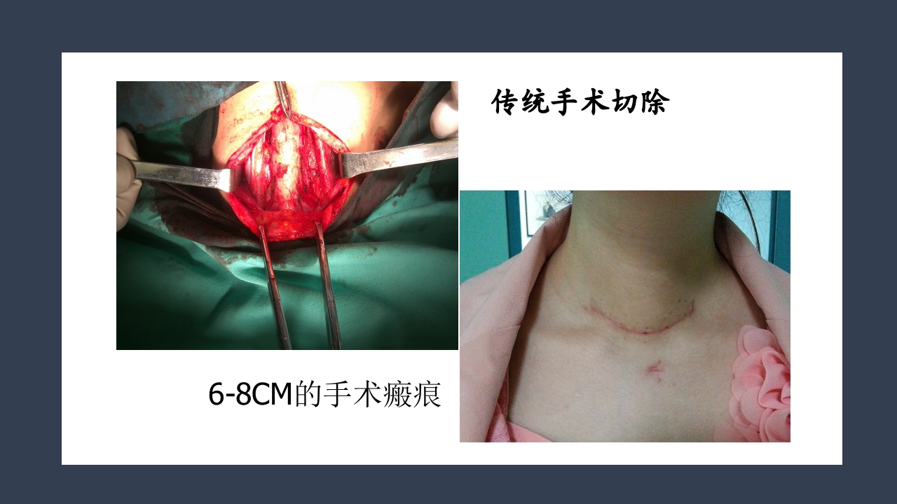 超声引导下甲状腺结节射频消融PPT课件5