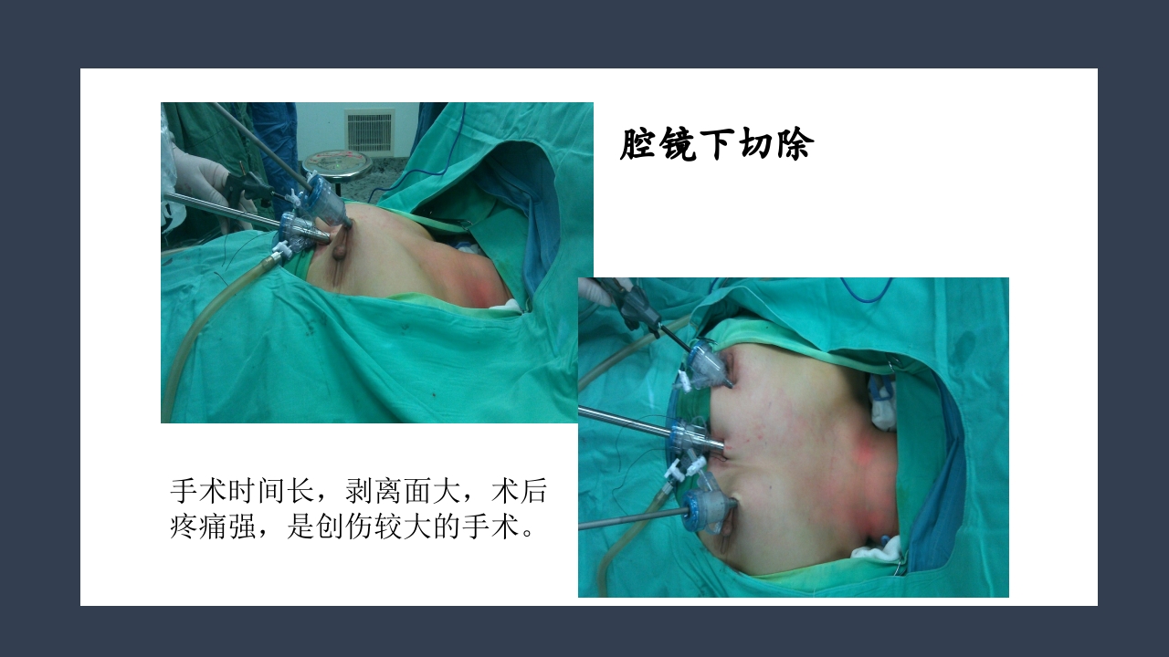 超声引导下甲状腺结节射频消融PPT课件6