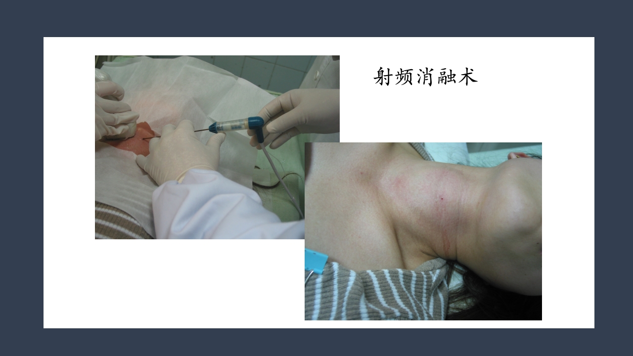 超声引导下甲状腺结节射频消融PPT课件7