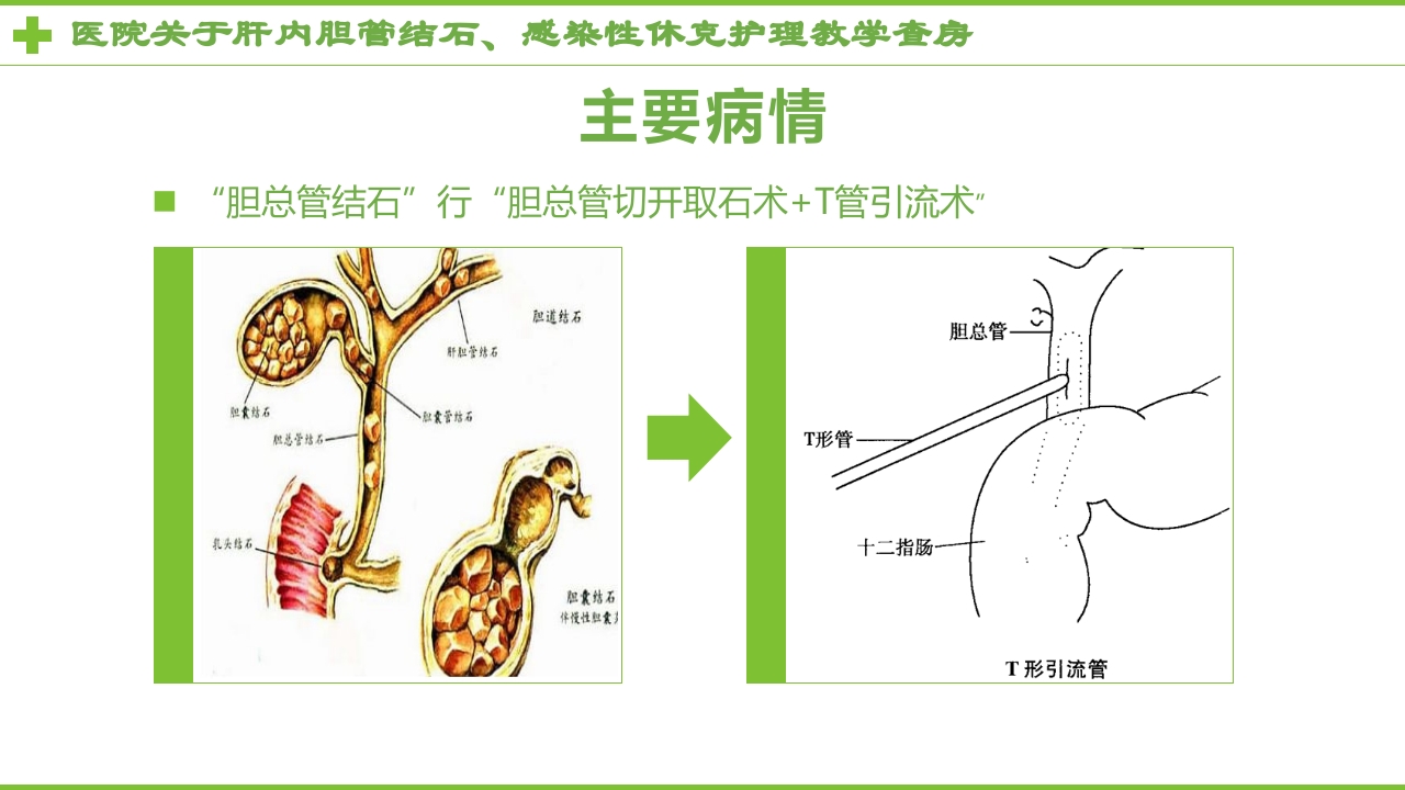感染性休克肝胆内结石护理教学查房PPT课件3
