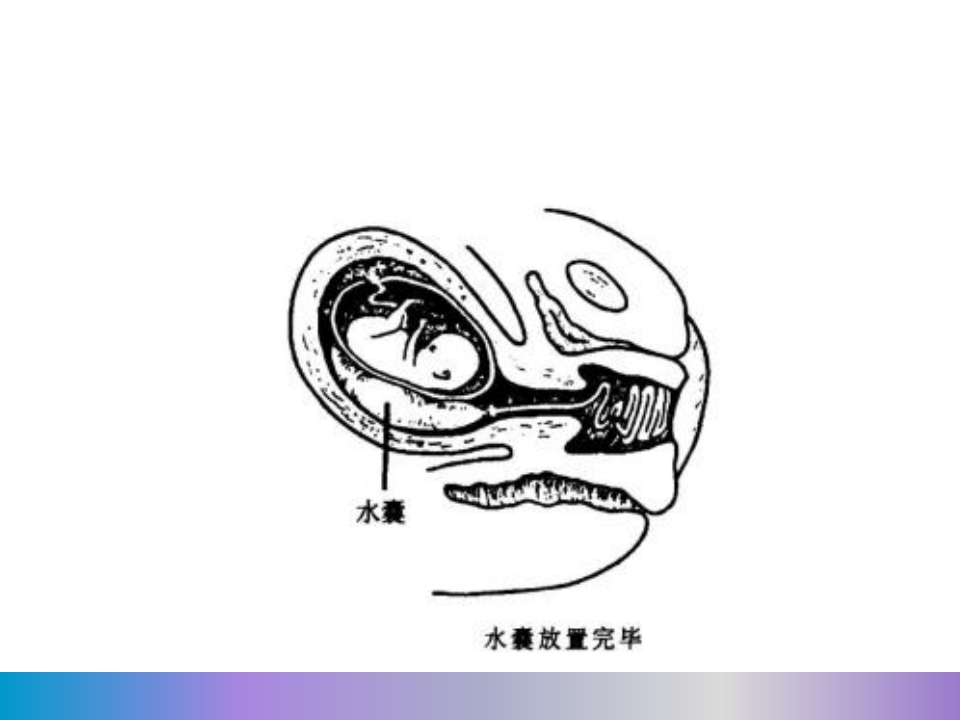 水囊引产术PPT课件17