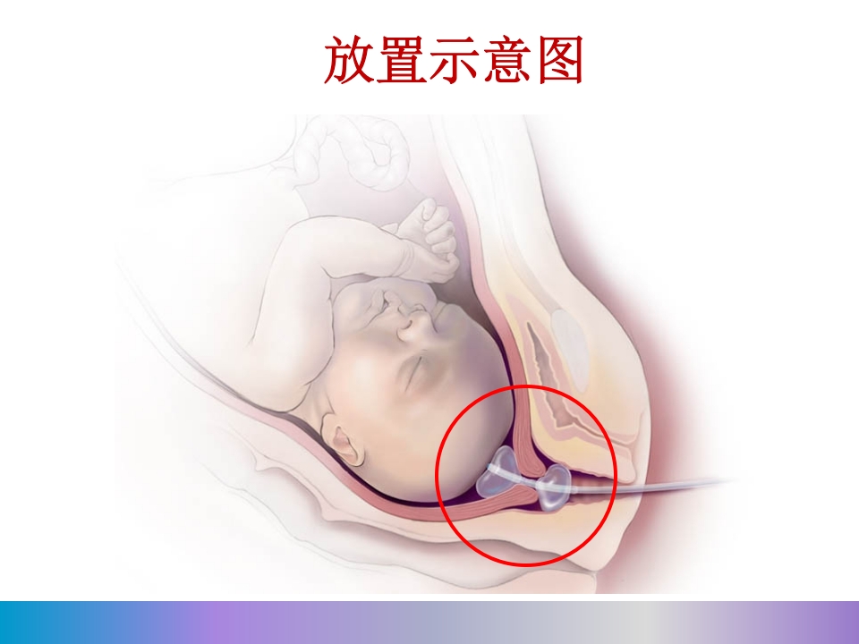 水囊引产术PPT课件19