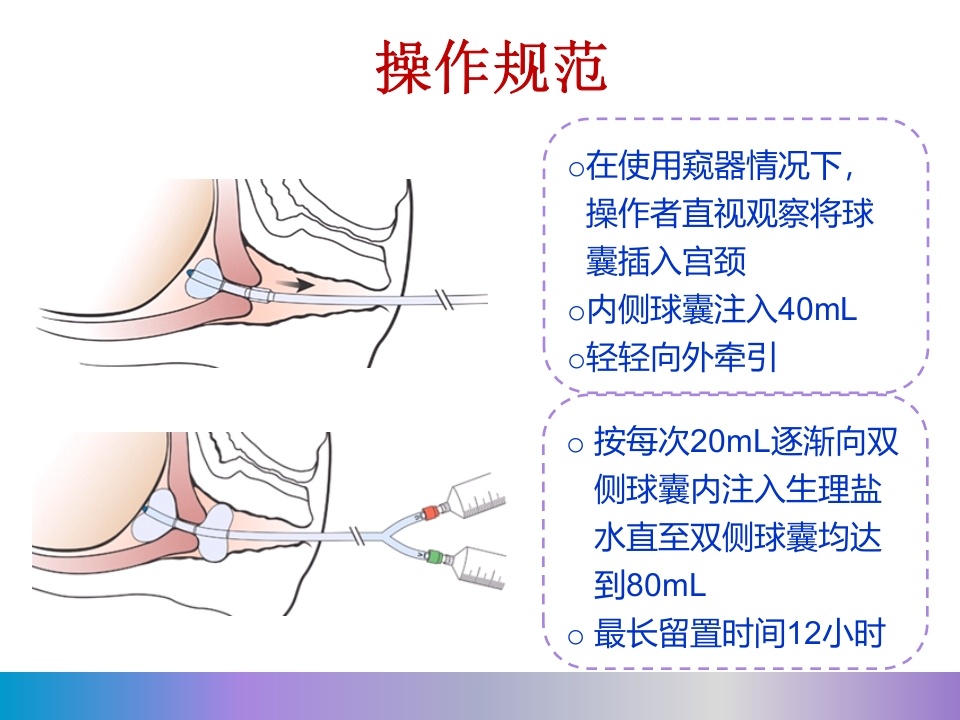 水囊引产术PPT课件29