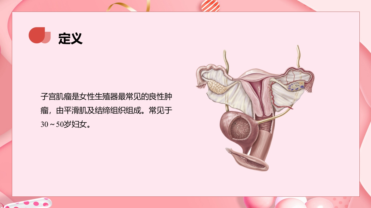 子宫肿瘤妇产科学课件PPT下载5