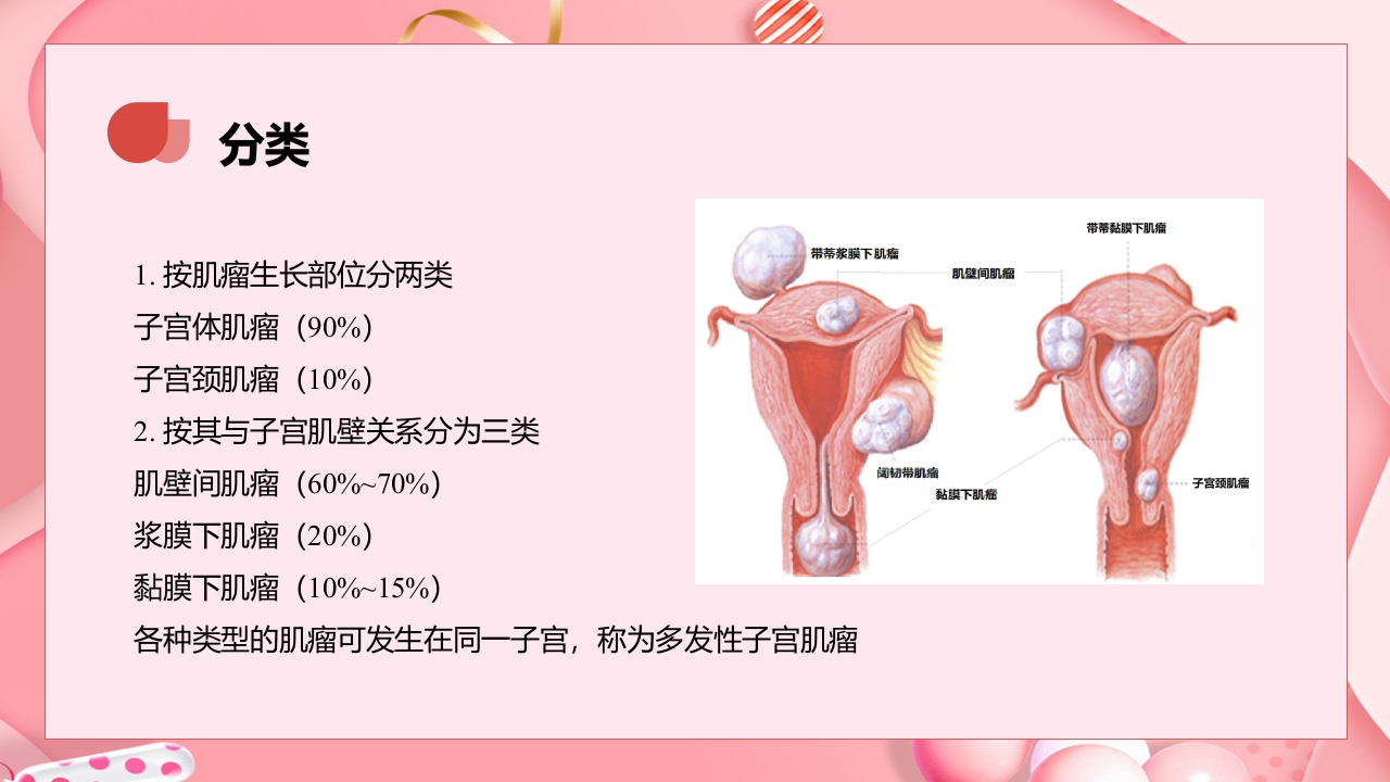 子宫肿瘤妇产科学课件PPT下载7