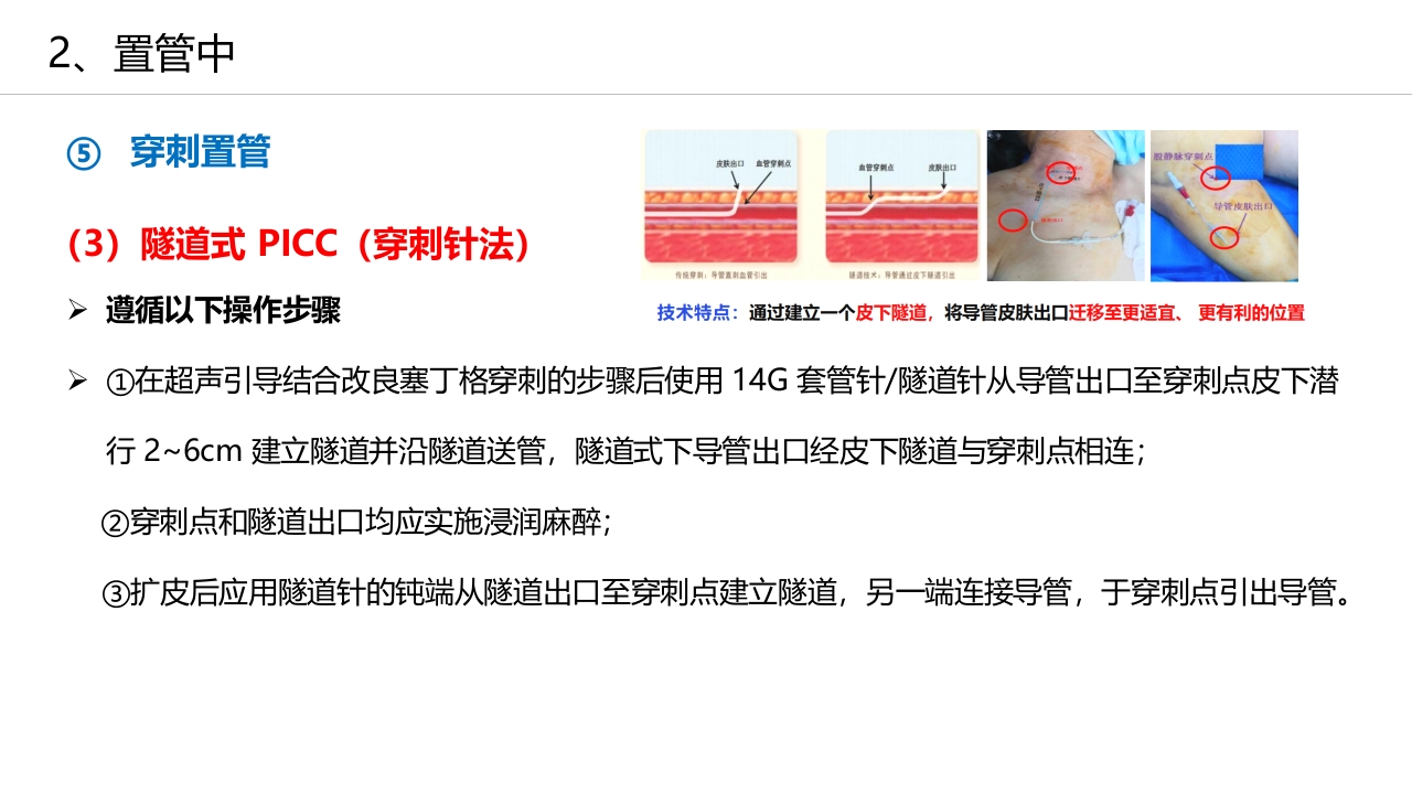 经外周静脉穿刺中心静脉置管(PICC)操作技术专家共识解读（2023版）PPT课件29