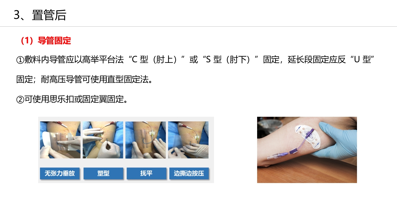 经外周静脉穿刺中心静脉置管(PICC)操作技术专家共识解读（2023版）PPT课件31