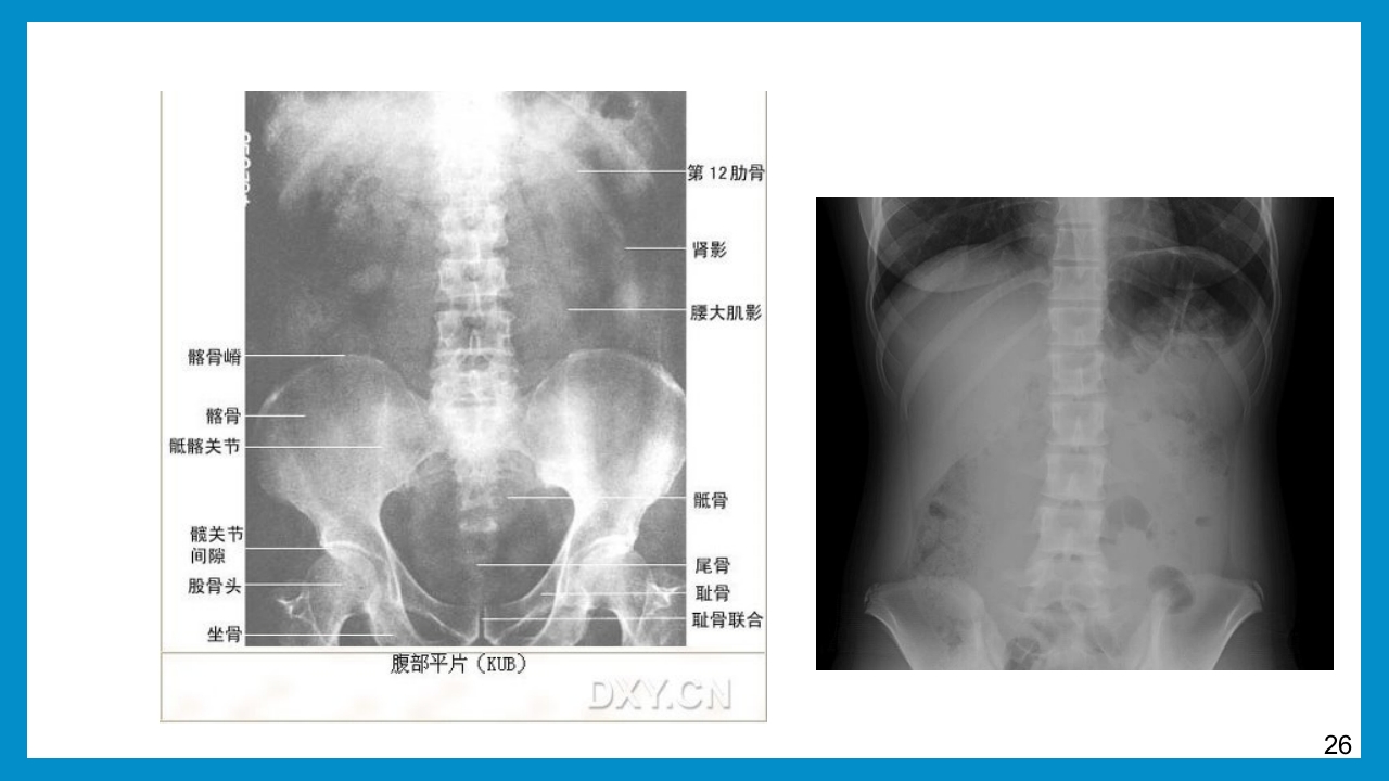 泌尿外科常见检查及其注意事项PPT课件26