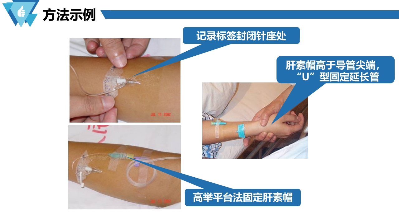 套管针介绍医疗PPT课件10