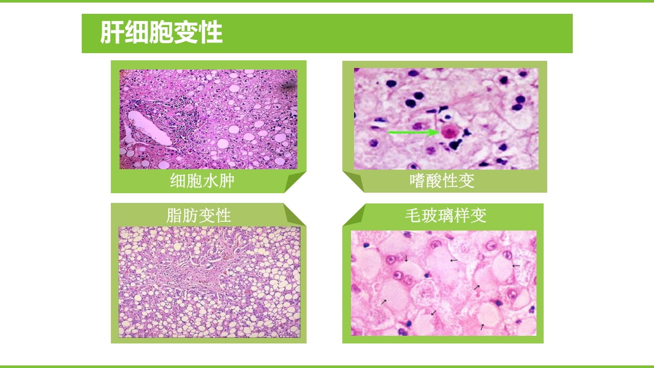 肝硬化PPT课件12