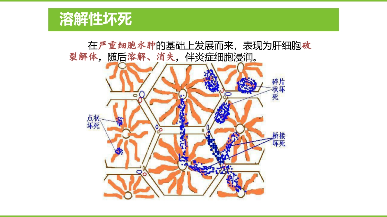 肝硬化PPT课件13