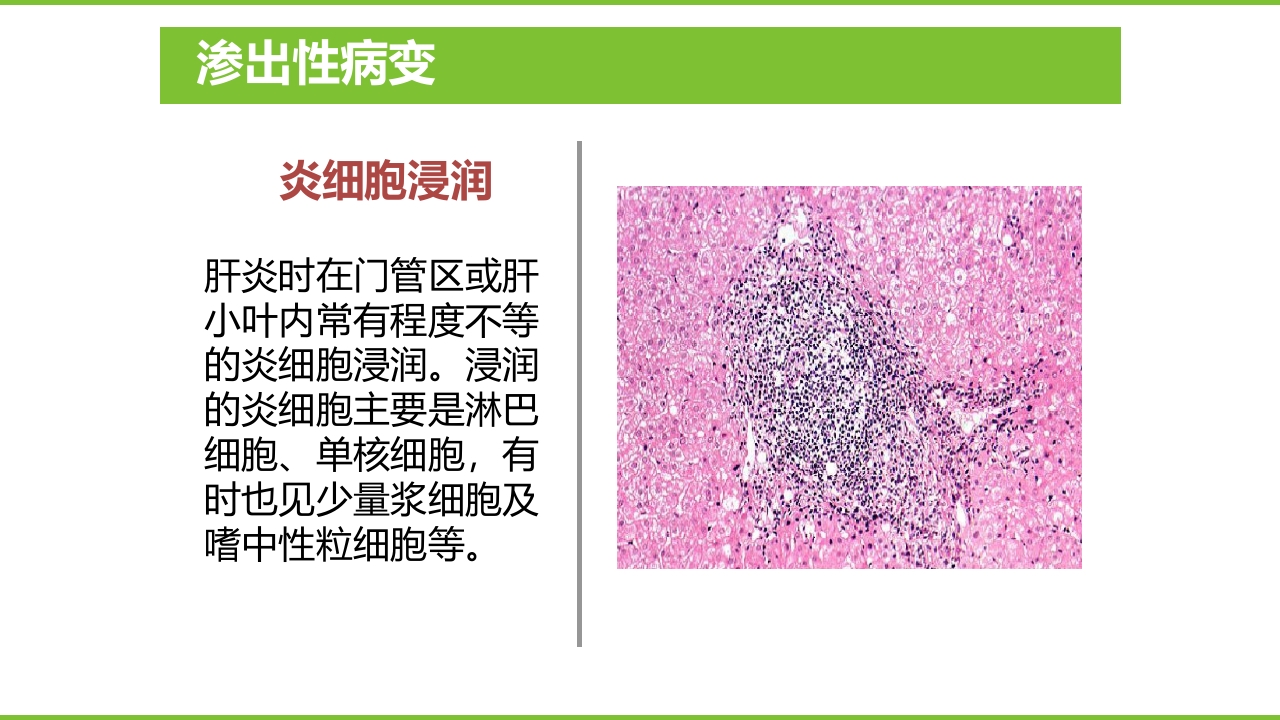 肝硬化PPT课件14