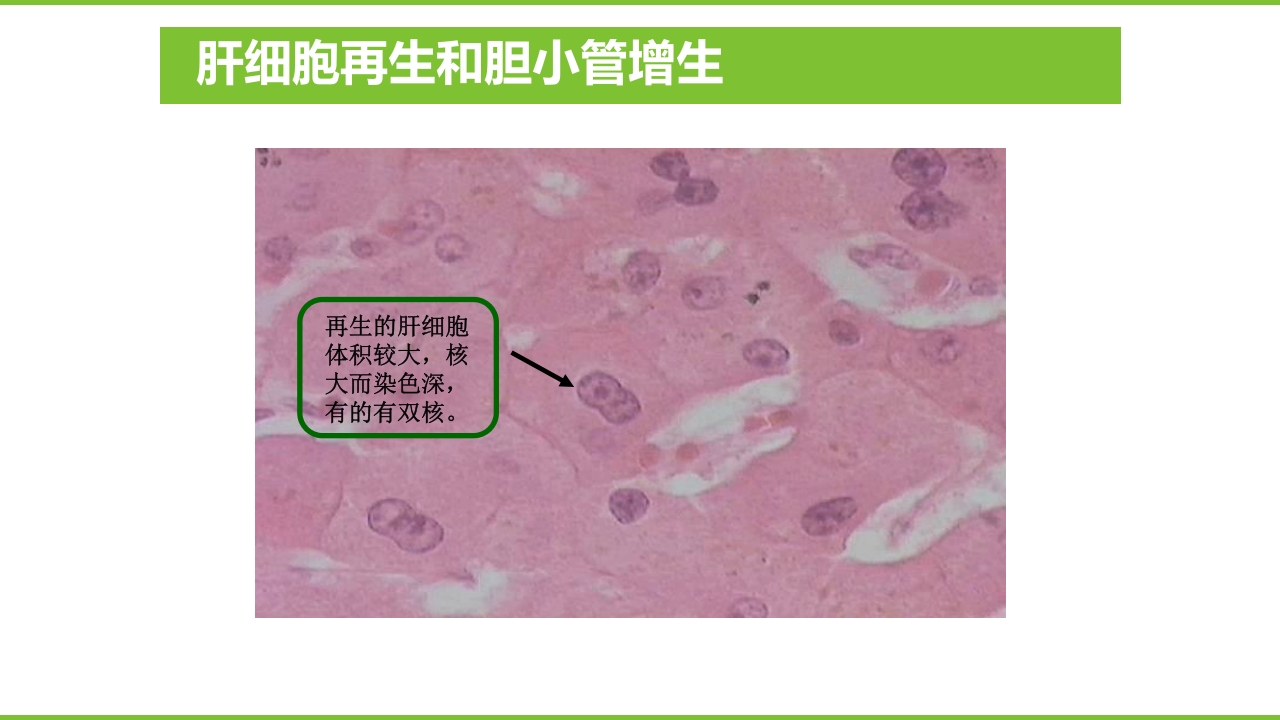 肝硬化PPT课件17