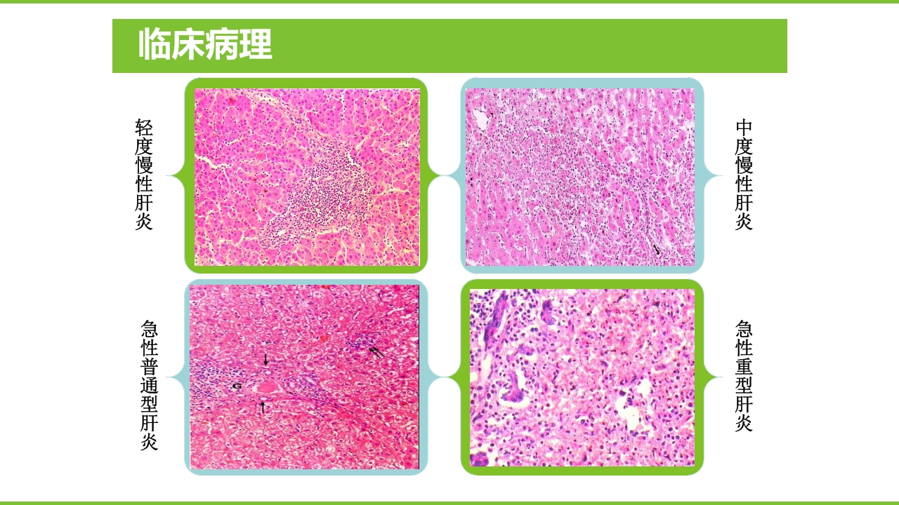 肝硬化PPT课件18