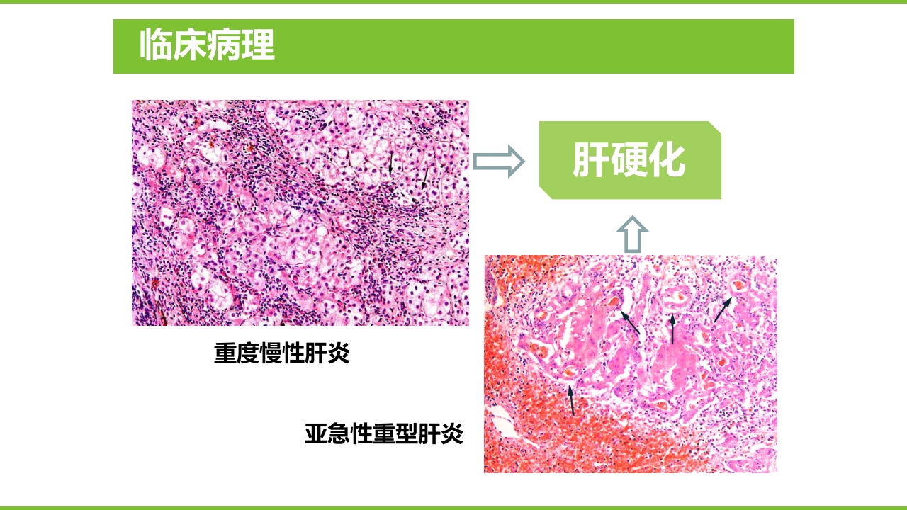 肝硬化PPT课件19