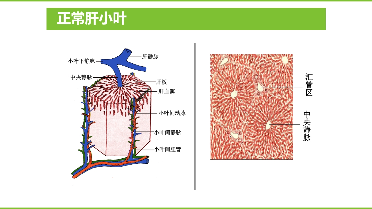 肝硬化PPT课件25